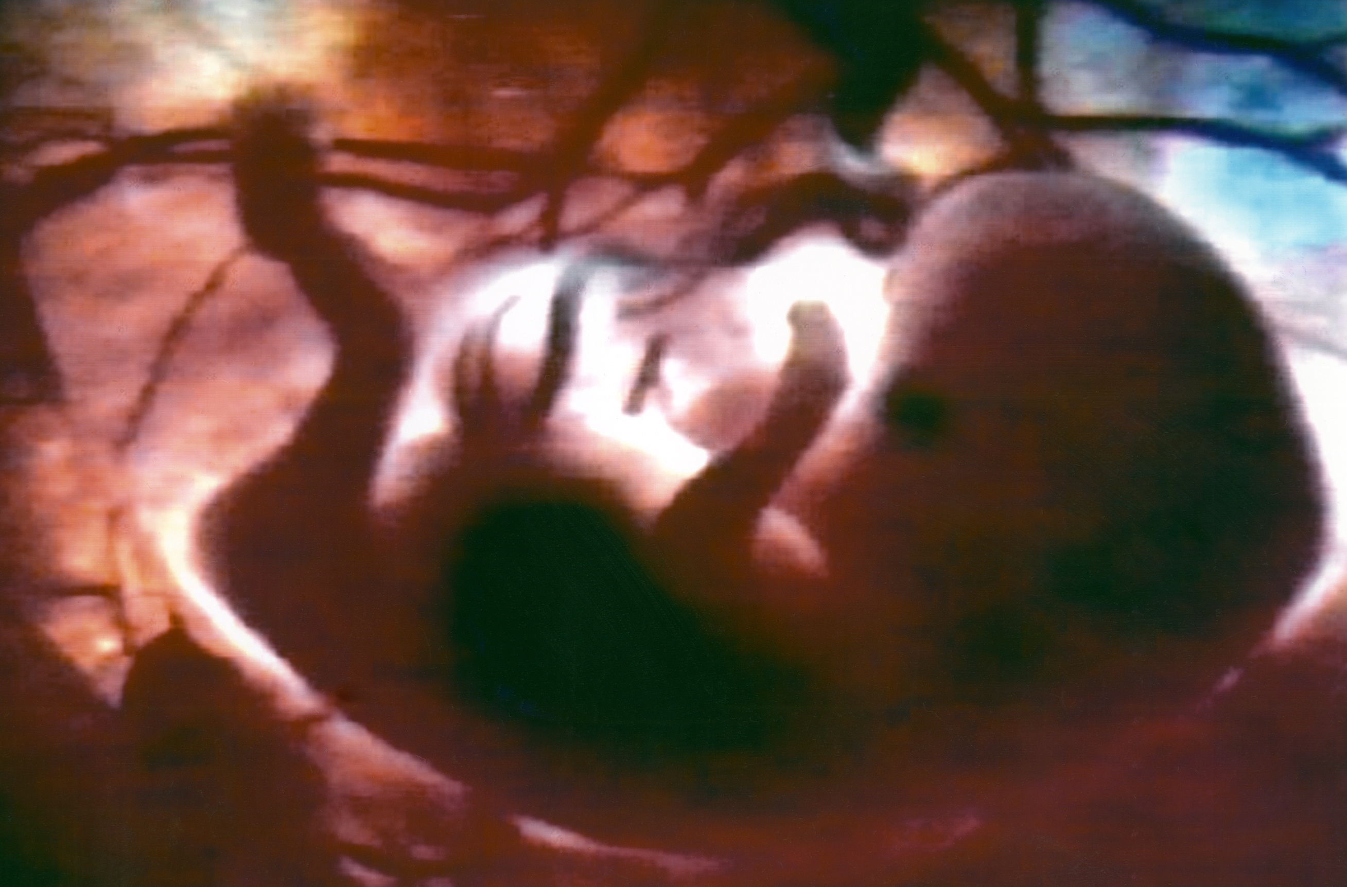 Mujer lleva semanas con feto muerto en el vientre
