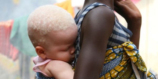 Encuentran mutilado el cuerpo de un bebé albino en Tanzania