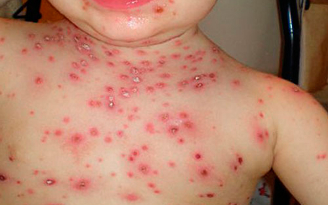 Crecen casos de varicela en el país por falta de vacunas