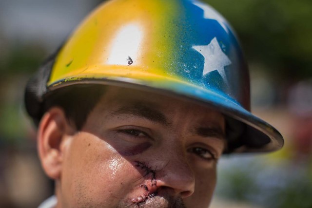 ACOMPAÑA CRÓNICA: VENEZUELA CRISIS. CAR01. CARACAS (VENEZUELA), 20/05/2017.- Un joven muestra la herida ocasionada por el impacto de una bomba lacrimógena hoy, sábado 20 de mayo de 2017, en Caracas (Venezuela). Con rostros que revelan que crecieron bajo la revolución que desde 1999 vive Venezuela, los milenials, sin distingo de clases y el entusiasmo propio de su edad, se han convertido en la vanguardia de las manifestaciones que desde hace 50 días mantiene la oposición en contra del presidente Nicolás Maduro. EFE/Miguel Gutiérrez