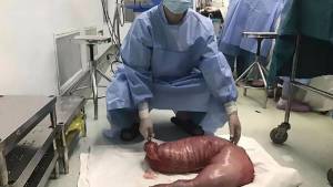 ¡OMG! Fue al hospital para que le sacaran 13 kilos de heces de su intestino (FOTO)
