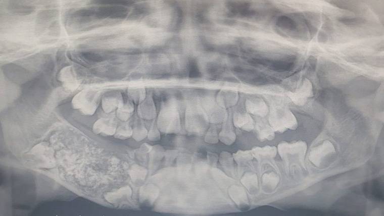 ¡Santo padre! Extraen más de 500 dientes de la boca de un niño de siete años (FOTOS)