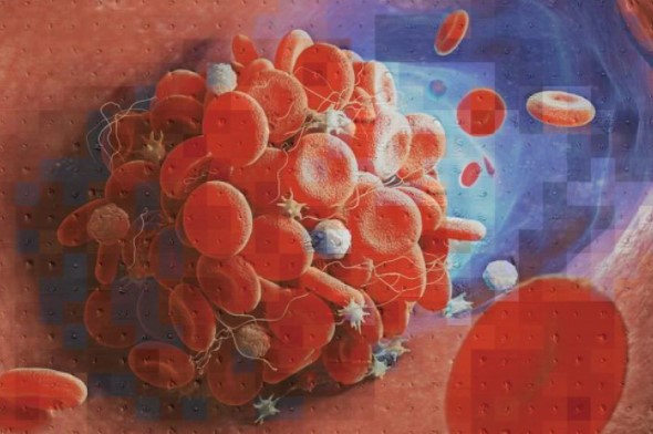 Descubren por qué algunos pacientes con Covid-19 desarrollan coágulos de sangre que ponen en peligro su vida