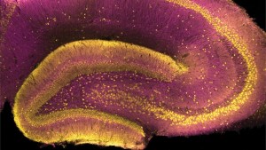 Científicos identifican en qué región del cerebro se puede originar la esquizofrenia